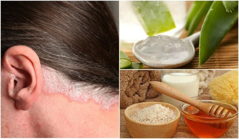 kokosolja mot psoriasis