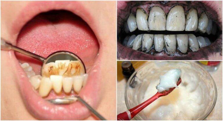 3 effektiva huskurer som avlägsnar tandsten
