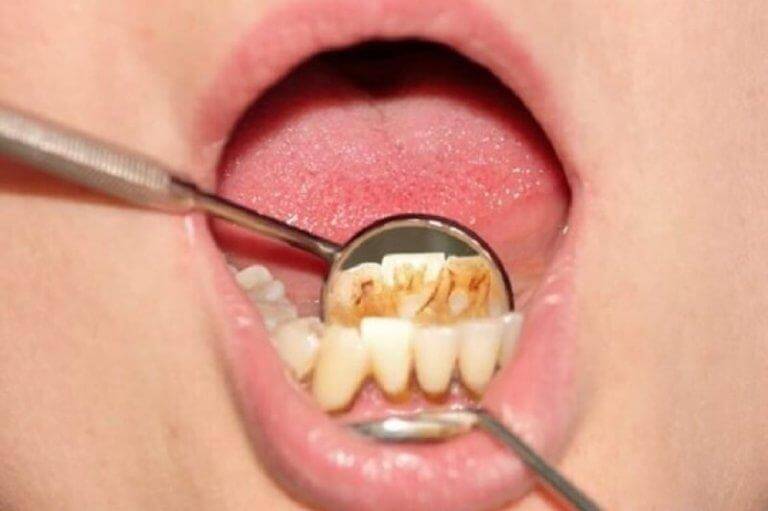 Det finns effektiva huskurer som avlägsnar tandsten