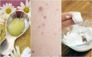 Fem behandlingar mot hudvårtor du kan göra hemma