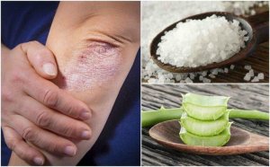 Bekämpa svampinfektioner med 5 naturliga lösningar