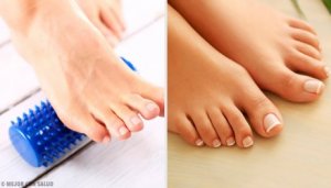 Kan man behandla hallux valgus utan kirurgi?