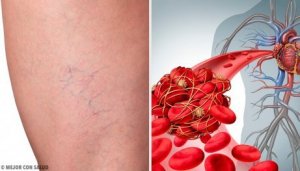 De tre bästa huskurerna mot flebit