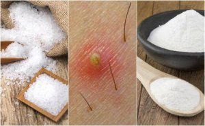 5 naturliga lösningar för inåtväxta hårstrån