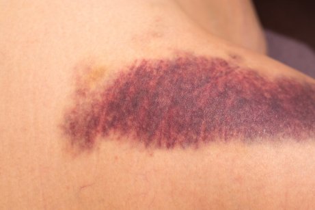 Purpura kan sprida sig