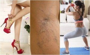 10 tips för att hjälpa dig att slippa åderbråck