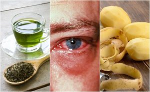 8 huskurer för att lindra bindhinnekatarr