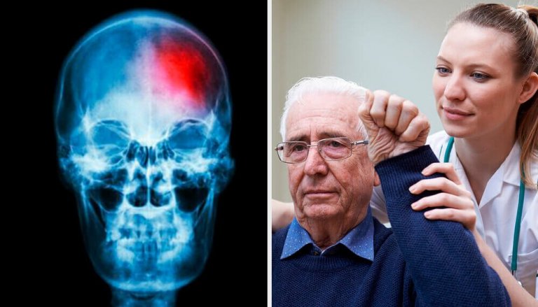 Vad är en mini-stroke? Tips för att upptäcka det