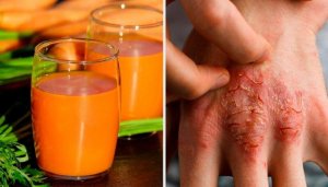 Bekämpa psoriasis med 7 naturliga behandlingar