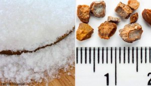 Bli av med njursten med 7 huskurer