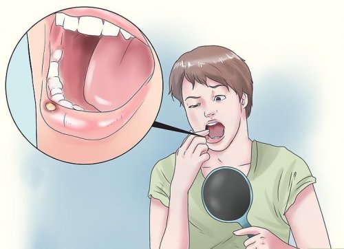 8 naturliga huskurer för blåsor i munnen