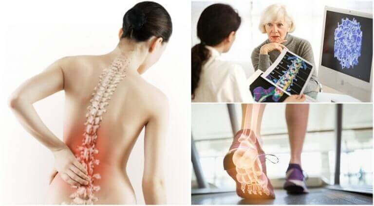 Fakta om osteoporos du bör känna till