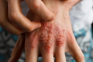 Behandla psoriasis med sarsaparill