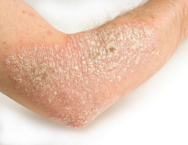 Utslag från psoriasis