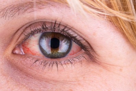 ögoninflammation vuxen medicin