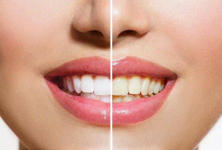 Så kan du bleka tänderna med naturliga produkter