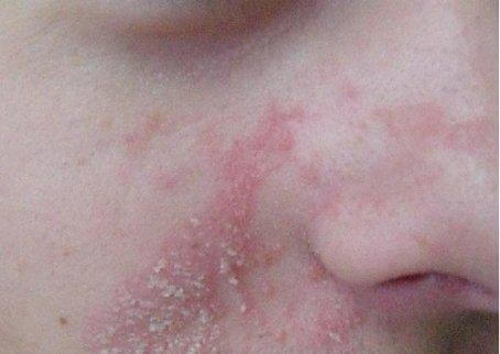 seborré-vid-näsområdet