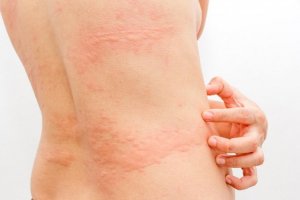 Tre naturliga behandlingar för nässelfeber