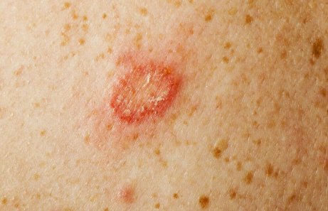 svampinfektion i huden
