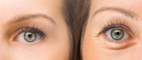 Hängiga ögonlock: motverka dem med naturliga huskurer