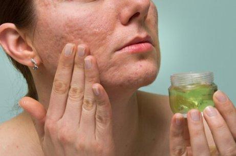 Använd aloe vera för att bekämpa akne