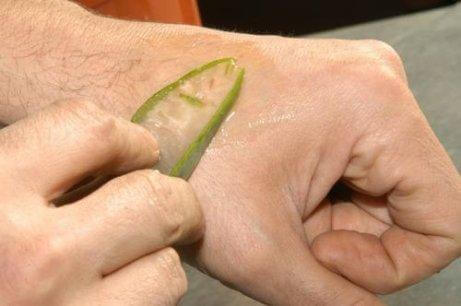 Aloe vera återgenererar huden<