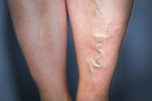 Behandla flebit med 5 naturliga lösningar