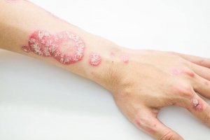 Motverka psoriasis med naturliga kurer