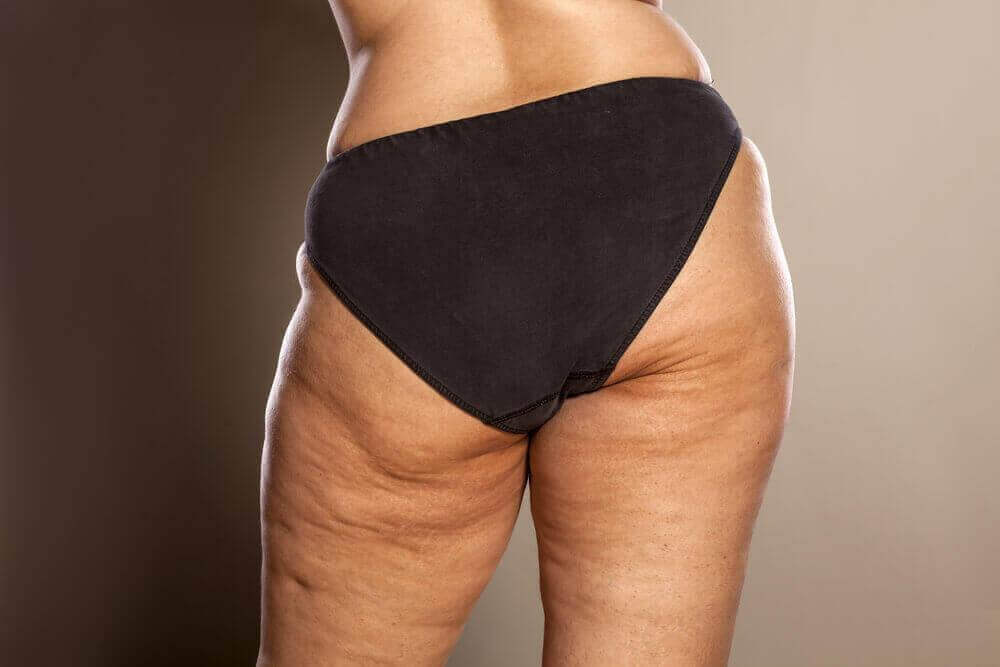 Ben med celluliter