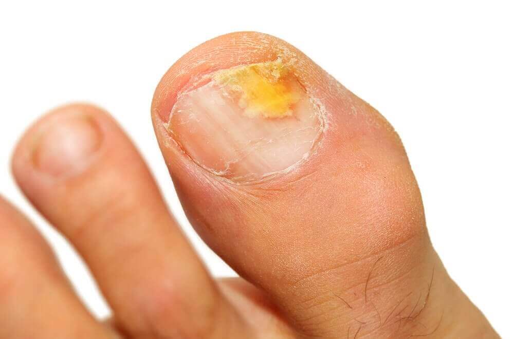 5 eteriska oljor för att bli av med nagelsvamp