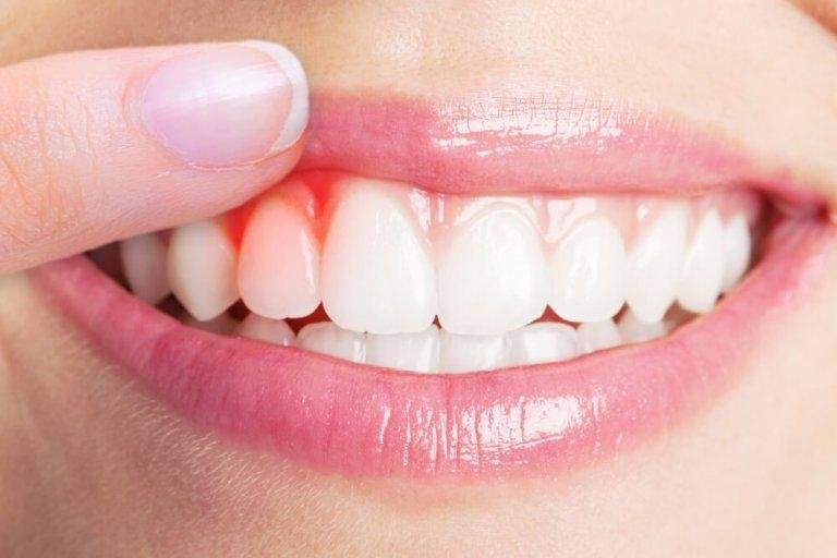 Så behandlar du en tandköttsinfektion - 5 huskurer