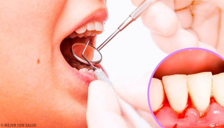 Symptomen på tandköttsinfektion är märkbara