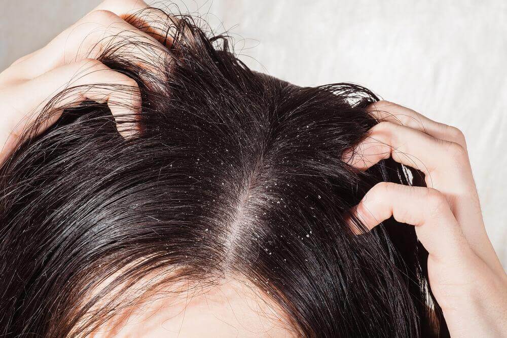 De 6 bästa botemedlen mot hårbottensvamp