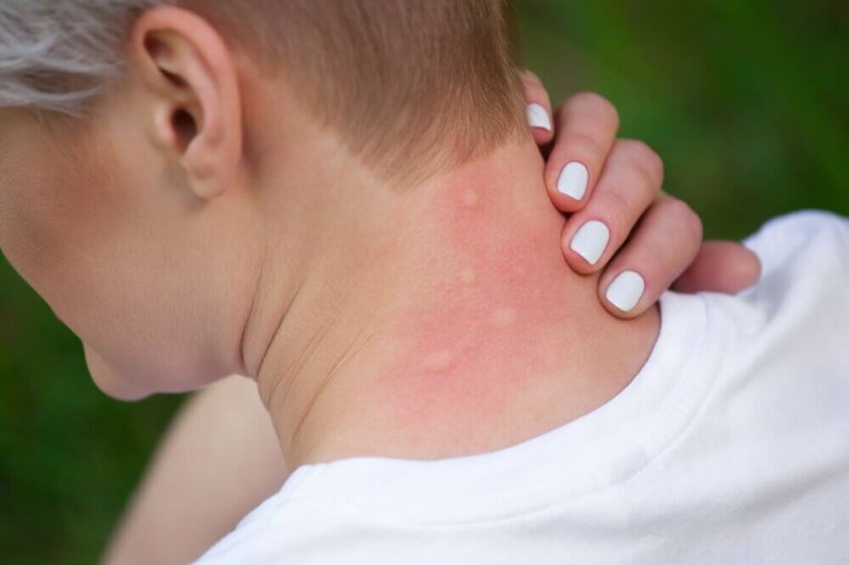 5 kurer för att lindra allergier mot insektsbett