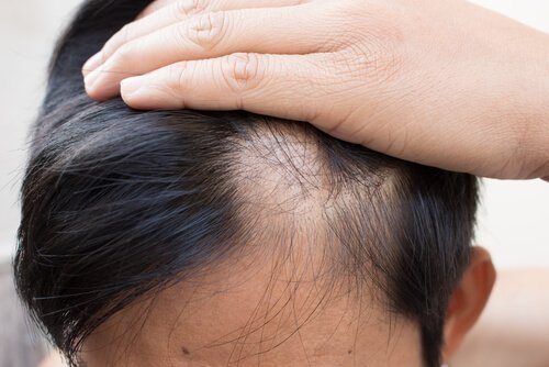 Alopeci