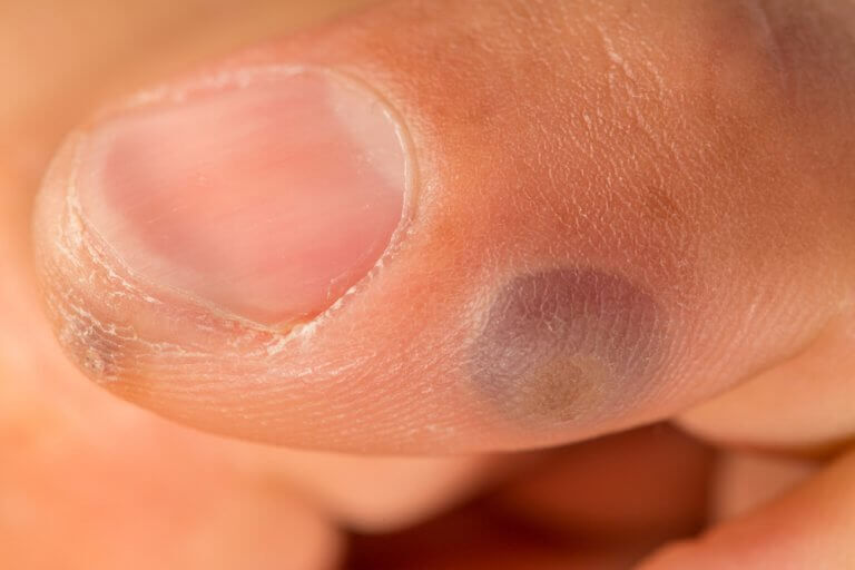 Vårta på finger