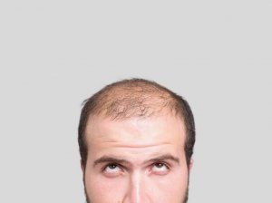 Tre naturliga huskurer för att behandla alopeci