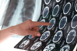 6 tips för att minska risken för stroke