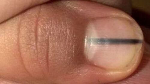 Svart linje på nageln kan vara tecken på cancer