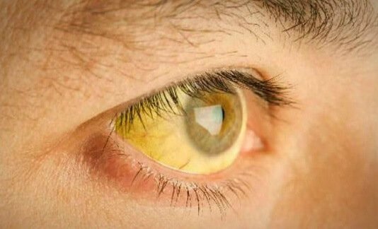 Gulsot är ett tecken på överskott av bilirubin