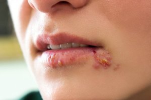 Hur man behandlar munherpes hos barn