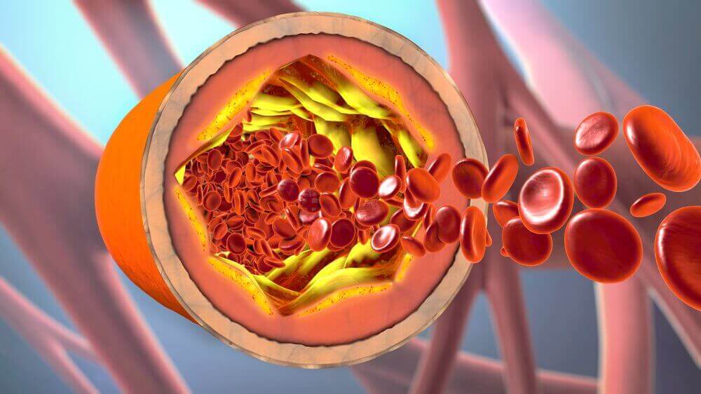 Höga kolesterolnivåer leder till igentäppta artärer