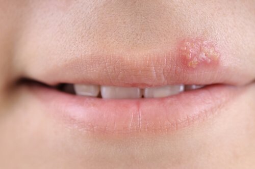 Det finns olika typer av herpesvirus