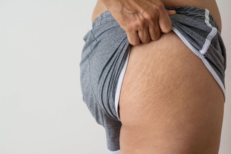5 behandlingar med kokosolja mot rupturer i huden