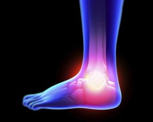 Hur man behandlar en stukning naturligt