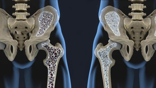 6 förebyggande kosttips mot osteoporos