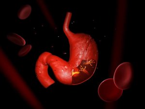 Huskurer med örter mot H. pylori-infektion