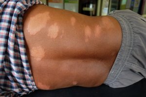Hur man lindrar symptom på Hansens sjukdom naturligt