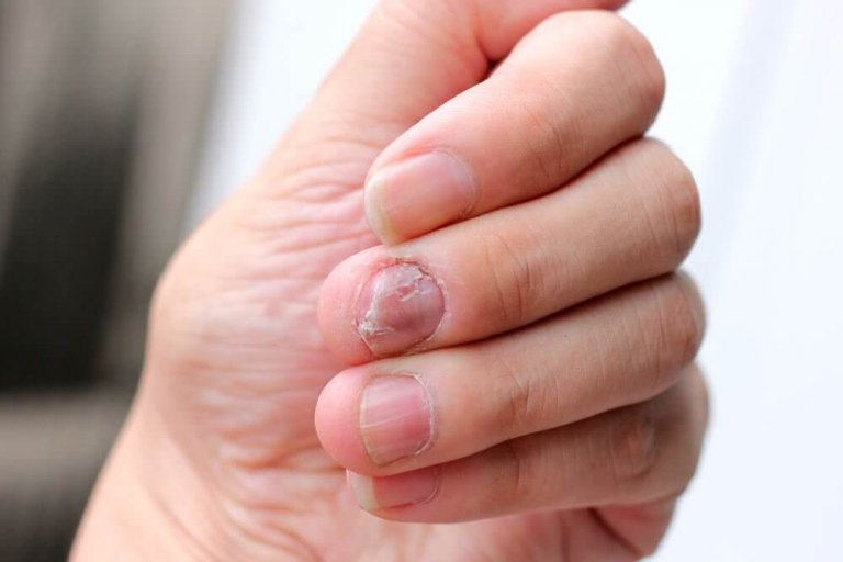 5 naturliga metoder som kan behandla nagelpsoriasis