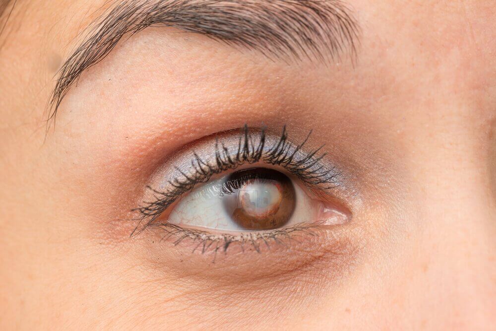 Symptom på katarakter i ögonen.